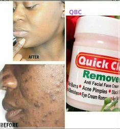 Original Quick Clear Face Cream clears, sunburn, dark spots and facial blemishes 1pcs 50g. Quick Clear Face Cream is very potent and come in handy in clearimg scars, dark spots, most facial blemises. You can mix a portion of this cream into your face cream or use it alone. Spot Face, Tretinoin Cream, Face Mapping Acne, Acne Prone Skin Care, Dark Spots On Face, Skin Burns, Natural Acne Remedies, Brown Spots Removal, Dark Under Eye