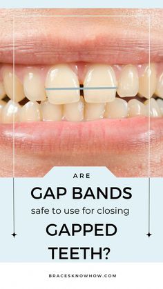 Blog description Close Gap In Teeth Diy, How To Close Your Gap In Your Teeth, Diy Braces For Teeth, Braces Inspiration, Gap Between Teeth, Teeth Gap, Braces Ideas, Diy Braces, Wisdom Tooth Extraction