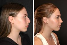 Refined Nose Tip, Defined Nose Bridge, Nose Rhinoplasty Before After, Nose Plastic Surgery Before After, Nose Before And After, Nose Jobs Before And After, Nose Job Before And After Rhinoplasty, Bulbous Nose Rhinoplasty Before After, Rhinoplasty Before After