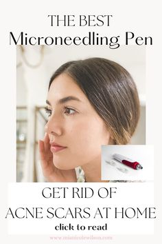 picture of woman with acne scars using microneedling pen to get rid of acne scars Acne Scar Cream, Microneedling Pen, Scar Cream, Derma Pen, Flawless Foundation