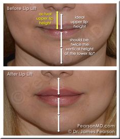 Lip Proportion - Upper Lip : Lower Lip The vertical height of the upper lip is ideally one half the height of the lower lip. Elongation of the cutaneous portion of the upper lip may lead to disproportion in this natural ratio, and may contribute to the appearance of a less aesthetically pleasing lip area. -  LIP LIFT IS MY DREAM PROCEDURE </3 Upper Lip Filler, Upper Lip Lift, Lip Surgery, Nose Reshaping, Lips Inspiration, Upper Lip Hair