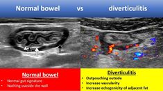 normal bowel vs divertctulitis is shown in two different colors and sizes