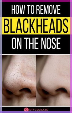 If your skin is anything like, which harbors visible pores filled with dirt, or in other words, blackheads, all I can say is that there is still hope. This article lists the best home remedies that will show you how to remove blackheads from nose at home. #Remedies #HomeRemedies #Blackheads #SkinCare #BeautyTips Natural Cold Remedies, Remove Blackheads From Nose, How To Remove Blackheads, To Remove Blackheads, Blackheads On Nose, Cold Sores Remedies, Remove Blackheads, Natural Sleep Remedies