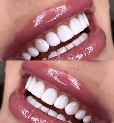 Whiten Your Teeth At Home, Loose Teeth, I Healed, Loose Tooth, Whiten Your Teeth