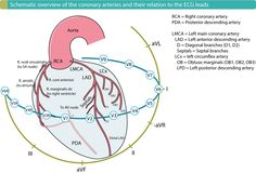 How to localize myocardial infarction / ischemia and identify the occluded artery (culprit) using ECG, in patients with acute myocardial infarction (STEMI). Sinoatrial Node, Coronary Circulation, St Elevation, Ekg Interpretation, Acute Coronary Syndrome, Flight Nurse, Coronary Artery, Nursing Exam