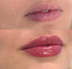 1ml Of Lip Filler, Lip Filler 5ml, 1.5 Lip Filler, Vermillion Border Lip Filler, Lip Filler Natural Look, Lip Filler 1 Ml, Lip Filler Before And After 1ml, Pout Lip Filler, Natural Lip Fillers 1ml