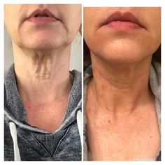 MicroNeedling & PRP | The Skin Cancer and Dermatology Center - Traverse City, Michigan Prp Face Before And After, Skin Care Routine 40s, Facial Procedure, Vampire Facial, Celebs Without Makeup, Skin Tightening Treatments