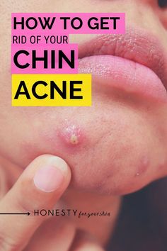 What is chin acne caused by? What causes acne on the chin? A scientist answers and it's not the answer you're expecting. How To Get Rid Of Spots Quickly, How To Get Ride Of Acne In A Day, How To Get Rid Of Cystic Acne Overnight, How To Get Rid Of Nodules, Chin Acne How To Get Rid Of, How To Get Rid Of Nodules Acne, How To Get Rid Of Chin Acne, Get Rid Of Chin Acne, Chin Acne Causes