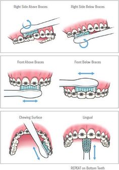 Dental Braces Colors, Braces Food, Cute Braces Colors, Braces Tips, Getting Braces, Haut Routine, Cute Braces, Kedokteran Gigi, Brace Face