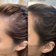 Make balding spot look fuller ! Scalp Micropigmentation Women, Medical Tattoo, Scalp Micropigmentation, Stretch Mark Removal, Bald Spot, South Pasadena, Pasadena California, Lost Hair, Aesthetic Coffee