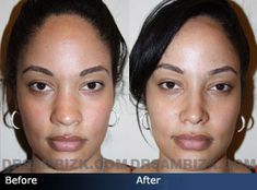 Wide Nose Rhinoplasty Before And After, Nose Job Before And After Front View, Rhinoplasty Before And After Bulbous, Rhinoplasty Front View, Nose Job Front View, Rhinoplasty Before After, Perfect Nose Front View, Ethnic Nose Job