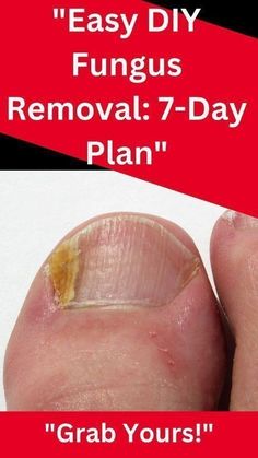 "Discover the best DIY treatments for nail fungus using natural solutions! These easy, budget-friendly remedies include everything from baking soda to hydrogen peroxide for fast and effective results. Clear up nail infections today and save this pin for later!" Fingernail Fungus