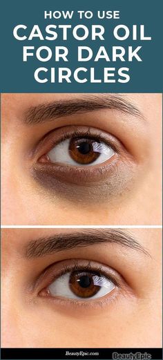 Reduce Eye Bags, Dark Circles Around Eyes, Eye Cream For Dark Circles, Dark Under Eye