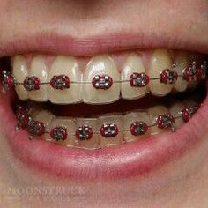 Braces Transformation, Fake Braces, Red Braces, Adult Braces, Kids Braces