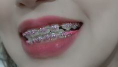 Brackets Aesthetic, Manifestation Quotes Aesthetic, Pink Braces, Smile Tips, Jewelry Teeth, Braces Colors Ideas, Teeth Gems, Cute Braces Colors, Braces Cost