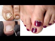 Watch as I transform these toe nails into a beautiful summer pedicure! HUGE transformation. This look is finished with crystals, and a deep eggplant nail pol... Pedicure Tutorial, Baby Blue Acrylic Nails, Spring Pedicure, Feet Pedicure, Summer Pedicure, Foot Pedicure, Pedicure Colors, Acrylic Nail Shapes, Blue Acrylic Nails