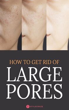 Pores on your face. Love them (fewer chances of that) or hate them, you just can Clear Pimples, Get Rid Of Pores, Big Pores, Lotion For Oily Skin, Acne Scarring, Tips For Oily Skin, Face Tips, Eye Skin Care, Reduce Pores