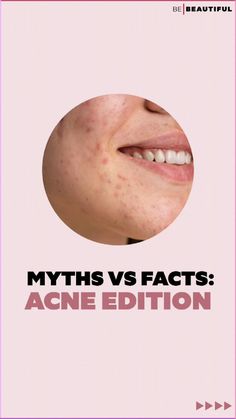 Get your facts straight!

#Skincare #Acne #Myth #MythBusting #Facts Myth And Fact, Myths Vs Facts, Skincare For Oily Skin, Skincare Acne, Skin Care Guide, Acne Skincare, Myth Busted, 8 March, Morning Skincare