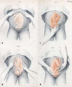 the stages of breast surgery are shown in this diagram, and there is no image to describe