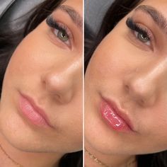 0.5ml Lip Filler Before And After, Lip Augmentation