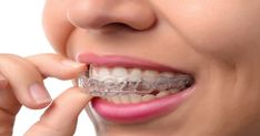 Invisalign Braces, Clear Braces, Kedokteran Gigi, Sedation Dentistry, Dental Braces