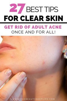 Cystic Acne – What Is It And How To Heal It? Blind Pimple, Pimples Under The Skin, Skin Moles, Prevent Pimples, Deeper Life, Clear Skin Tips, Natural Cough Remedies, Clearer Skin