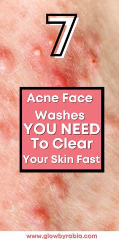 Looking for an acne face wash that actually works? Check this pharmacist Guide on the best acne face wash acne face wash, acne face wash best, acne face wash for sensitive skin, face wash for acne prone skin, face wash for acne, face wash for acne and oily skin, cleanser for acne, acne skincare routine, how to treat acne at home, salicylic acid cleanser, face wash for cystic acne, Face Wash For Sensitive Skin, Oily Skin Cleanser, Face Wash For Acne, Cleanser For Acne, Sensitive Skin Face Wash, Painful Acne, Clear Your Skin