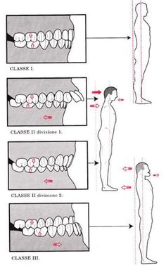 Esquema de oclusão e postura segundo Bernard Bricot Tmj Headache, Dental Assistant Study, Dental Hygiene Student, Dental Bonding, Dental World, Bolesti Chrbta, Dental Hygiene School, Dental Anatomy, Dental Fun