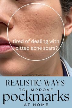 guide to get rid of deep acne scars Best Acne Scar Removal, Remove Skin Tags Naturally, Natural Acne Remedies, How To Get Rid Of Pimples, Acne Solutions, Face Acne, Acne Remedies, Skin Pores