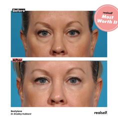 10 Things I Wish I Knew Before Restylane Under Eye Wrinkles Filler, Filler Under The Eyes, Eye Fillers Before And After, Filler Under Eyes Before And After, Undereye Filler Before And After, Tear Trough Filler Before After