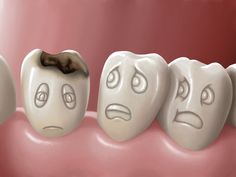 If you're experiencing issues like tooth sensitivity, toothache, visible pores, it could be due to dental cavities. Now try some home remedies for cavities to save your tooth from further damage. Cavity Pain, Tooth Sensitivity Relief, Cavity Remedy, Home Remedies For Cavities, Dental Health Crafts, Tooth Pain Remedies, Tooth Pain Relief, Cavities In Kids, Tooth Ache Relief