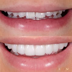 Before and after results of a Suzie McIntosh's porcelain veneers done by Dr. Dee. Whitening Teeth, Porcelain Veneers, Perfect Teeth, Nice Teeth, Tooth Enamel