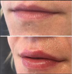 Facial Balancing, Lip Flip, Facial Fillers, Lip Filler, Makeup Makeover, Dermal Fillers, Lip Fillers, Skin Care Women