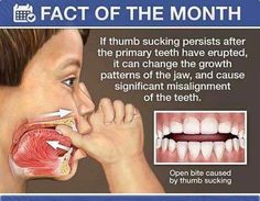 If thumb sucking persists after the baby primary teeth have erupted, it can change the growth patterns of the jaw, and cause significant misalignment of teeth. Dental Facts, Dental Life, Dental Marketing, Dental Kids, Dental Humor, Pediatric Dentistry, Dental Problems