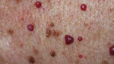 Raised bumps on the skin are common. Learn about possible causes, ranging from acne to skin cancer, and different treatment options. Cherry Angioma Removal, Bumps On Legs, Cherry Angioma, Tag Remover, Skin Bumps