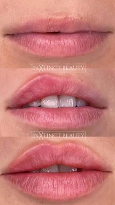 Russian Lip Filler Technique, Lip Filler Injection, Lip Filler Technique, Russian Lip Filler, Filler Injection, Hyaluronic Acid Lips, Face Fillers