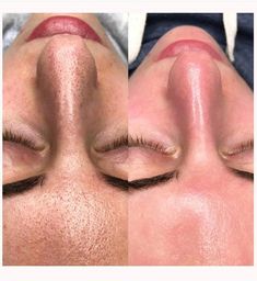 Hydrafacial Post, Massage Images, Facial Room, Skin Studio