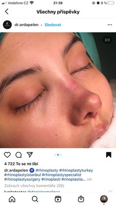 Nose Job Before And After Bulbous, Button Nose Nose Job, Nose Job Inspo Front View, Nose Job Inspiration Front View, Straight Nose Front View, Rhinoplasty Front View, Pretty Nose Front View, Front View Nose, Nose Job Front View