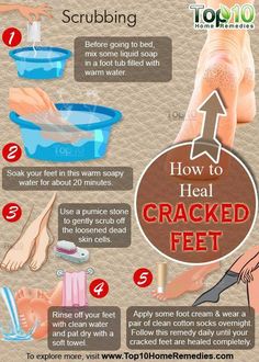 Helpful Essential Oils Tips For Cracked Heels Essential Oils #CrackedHeelsEssentialOils Cracked Heel Remedies, Dry Cracked Heels, Cracked Heel, Foot Soak, Cracked Heels, Healthy Routine