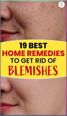 19 Best Home Remedies To Get Rid Of Blemishes: Sitting at home and hiding from the world is not the solution. You have to find a way to get clean and clear skin and regain your confidence. This article is going to be your social lifesaver! #beauty #beautytips #blemishes #remedies Hiding From The World, Clean And Clear Skin, Blind Pimple, Hydrating Skincare, Natural Acne, Acne Solutions, Skin Blemishes, Summer Skincare, Unclog Pores