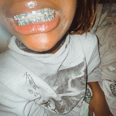 Preppy Essentials, Cute Braces, Brace Face, Braces Colors