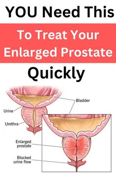 Discover effective ways to treat an enlarged prostate gland safely at home. Learn about natural remedies, foods, and exercises that can help shrink the prostate and improve prostate health. Address urinary problems with holistic treatment options, including yoga and prostatitis management. Explore simple tips and cures for men to enhance urination comfort. Improve your life with these essential strategies to treat and manage prostate issues naturally. #prostatehealth #home #remedies #men #exercise #yoga #urination Prostate Gland, Healthy Lunch Recipes, Healthy Chicken Recipes, Health Awareness, Simple Tricks, Home Remedies, Gravity