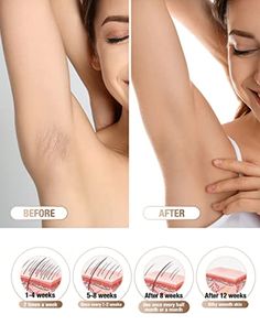 Best Permanent Hair Removal, Painless Hair Removal, Ipl Hair Removal, Hair Removal Permanent, Beauty Products Photography