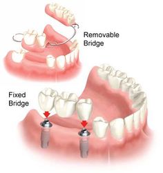 #Dental #bridges in #chandigarh #mohali Types of Dental Bridges are : - #Traditional bridges - #Cantilever bridges - #Resin-bonded bridges For more details: www.dentalbhaji.com Call us: 98155-02453 Free Dental Implants, Tooth Implant, Temporary Tooth, Implant Dentist, Dental Implant Surgery, Laser Teeth Whitening