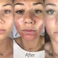 Microneedling Face Before And After, Microneedle Before And After, Dermarolling Before And After, Skin Needling Before And After, Prp Before And After, Microneedling Before And After At Home, Prp Microneedling Before And After, Vampire Facial Before And After, Prp Face Before And After