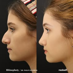 Nose Job Recovery, Rhinoplasty Recovery, Nose Surgery Rhinoplasty, Improve Breathing, Drawing Pencil Sketches