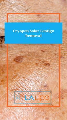 Are you anxious by annoying sun damage on your skin? Did you know that this could now be eradicated at our friendly clinic by using the latest innovations in cryotherapy? Our derma consultants get rid of this skin imperfection by using a fine jet of pressurized N2O that freezes the annoying tissue without damaging the healthy skin around it. This is a fast, non-scarring, and almost painless treatment ideal for people of all walks of life! Basal Cell, Scarring, Skin Imperfection, Things Under A Microscope, Cosmetic Procedures, Eye Area, Healthy Skin, Did You Know