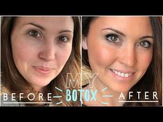 Crows Feet Botox Before After, Botox Brow Lift Before And After, Botox For Headaches, Botox Brow Lift, Best Skin Cream, Lip Scrub Recipe