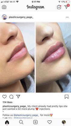 Lip Injections Juvederm, Lip Fillers Juvederm, Eye Lift Surgery, Diy Lip Plumper, Lip Surgery, Lips Inspiration, Botox Lips, Facial Fillers, Facial Aesthetics