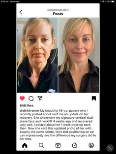 Facelift Recovery, Mid Face Lift, Face Plastic Surgery, Mommy Makeover Surgery, Mini Face Lift, Anti Aging Skin Care Diy, Rhinoplasty Nose Jobs, Face Surgery